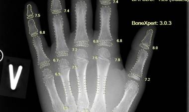 Aarthi Scans & Labs Rolls Out AI-Based Bone Age Technology across 100 Centres in India