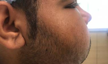 Successful scarless ENT surgery of rare massive jaw tumour at MGM Healthcare, Chennai