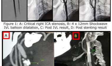 Apollo Hospitals reports first successful use of Intravascular Lithotripsy in India in treatment of severely calcified carotid artery stenosis