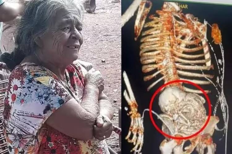 56 வருடங்களாக வயிற்றில் இருந்த இறந்த குழந்தை...உயிரிழந்த 81 வயது பெண்