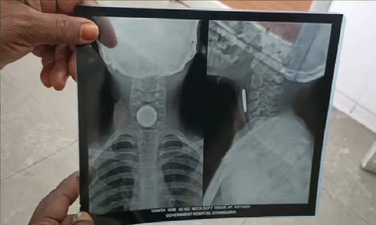 5 ரூபாய் நாணயத்தை விழுங்கிய 10 வயது சிறுவன்